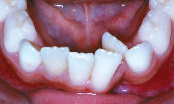 Crowding Wilsonville Orthodontics in Wilsonville, OR