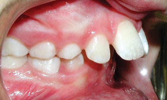 Protrusion Wilsonville Orthodontics in Wilsonville, OR