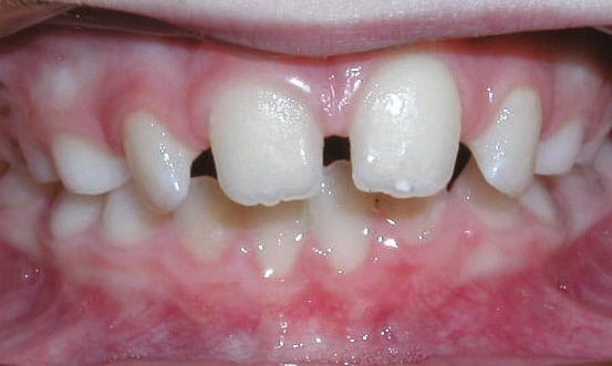 Spacing Wilsonville Orthodontics in Wilsonville, OR