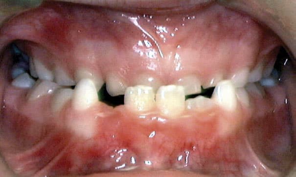 Underbite Wilsonville Orthodontics in Wilsonville, OR