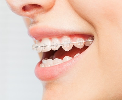 Ceramic Braces Wilsonville Orthodontics in Wilsonville, OR