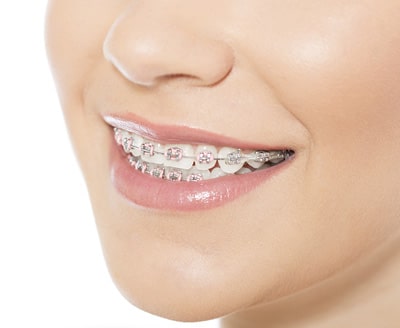 Metal Braces Wilsonville Orthodontics in Wilsonville, OR