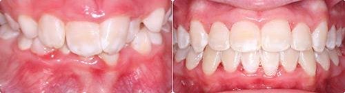 Before and After Orthodontic Treatment Wilsonville Orthodontics in Wilsonville, OR