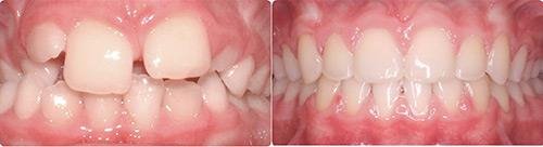 Before and After Orthodontic Treatment Wilsonville Orthodontics in Wilsonville, OR
