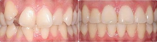 Before and After Orthodontic Treatment Wilsonville Orthodontics in Wilsonville, OR