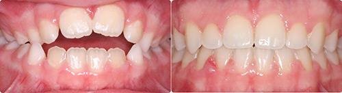 Before and After Orthodontic Treatment Wilsonville Orthodontics in Wilsonville, OR