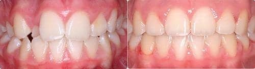 Before and After Orthodontic Treatment Wilsonville Orthodontics in Wilsonville, OR