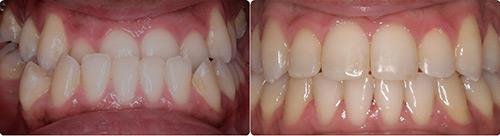 Before and After Orthodontic Treatment Wilsonville Orthodontics in Wilsonville, OR