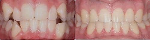 Before and After Orthodontic Treatment Wilsonville Orthodontics in Wilsonville, OR