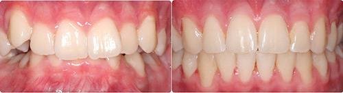 Before and After Orthodontic Treatment Wilsonville Orthodontics in Wilsonville, OR