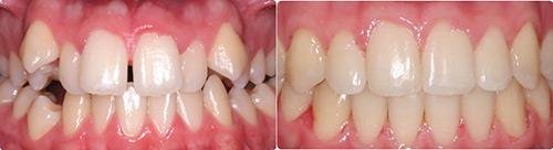 Before and After Orthodontic Treatment Wilsonville Orthodontics in Wilsonville, OR
