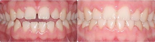 Before and After Orthodontic Treatment Wilsonville Orthodontics in Wilsonville, OR