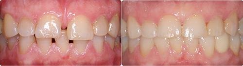 Before and After Orthodontic Treatment Wilsonville Orthodontics in Wilsonville, OR