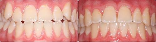 Before and After Orthodontic Treatment Wilsonville Orthodontics in Wilsonville, OR
