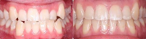 Before and After Orthodontic Treatment Wilsonville Orthodontics in Wilsonville, OR