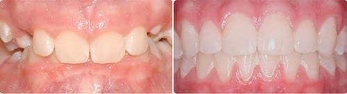 Before and After Orthodontic Treatment Wilsonville Orthodontics in Wilsonville, OR