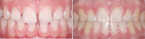 Before and After Orthodontic Treatment Wilsonville Orthodontics in Wilsonville, OR