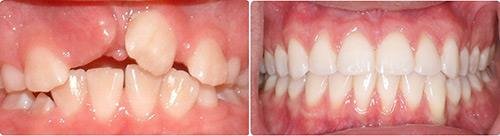 Before and After Orthodontic Treatment Wilsonville Orthodontics in Wilsonville, OR