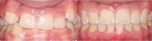 Before and After Orthodontic Treatment Wilsonville Orthodontics in Wilsonville, OR