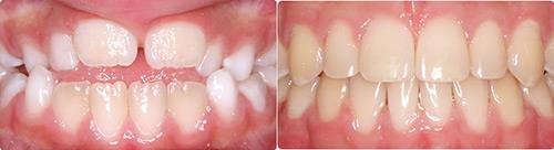 Before and After Orthodontic Treatment Wilsonville Orthodontics in Wilsonville, OR