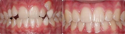 Before and After Orthodontic Treatment Wilsonville Orthodontics in Wilsonville, OR