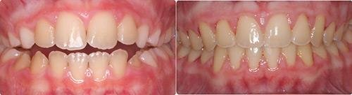 Before and After Orthodontic Treatment Wilsonville Orthodontics in Wilsonville, OR