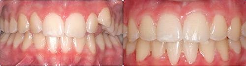 Before and After Orthodontic Treatment Wilsonville Orthodontics in Wilsonville, OR