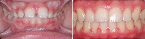 Before and After Orthodontic Treatment Wilsonville Orthodontics in Wilsonville, OR