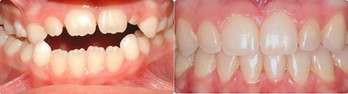 Before and After Orthodontic Treatment Wilsonville Orthodontics in Wilsonville, OR