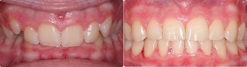 Before and After Orthodontic Treatment Wilsonville Orthodontics in Wilsonville, OR
