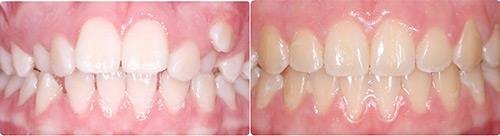 Before and After Orthodontic Treatment Wilsonville Orthodontics in Wilsonville, OR