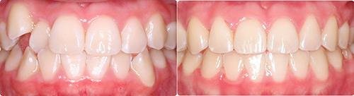 Before and After Orthodontic Treatment Wilsonville Orthodontics in Wilsonville, OR