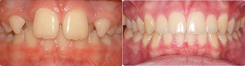 Before and After Orthodontic Treatment Wilsonville Orthodontics in Wilsonville, OR