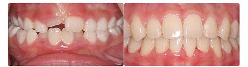 Before and After Orthodontic Treatment Wilsonville Orthodontics in Wilsonville, OR