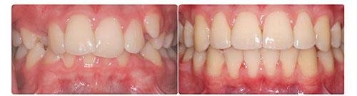 Before and After Orthodontic Treatment Wilsonville Orthodontics in Wilsonville, OR