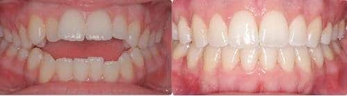Before and After Orthodontic Treatment Wilsonville Orthodontics in Wilsonville, OR