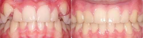 Before and After Orthodontic Treatment Wilsonville Orthodontics in Wilsonville, OR