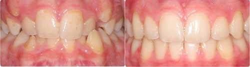 Before and After Orthodontic Treatment Wilsonville Orthodontics in Wilsonville, OR