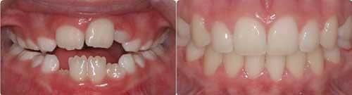 Before and After Orthodontic Treatment Wilsonville Orthodontics in Wilsonville, OR