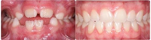 Before and After Orthodontic Treatment Wilsonville Orthodontics in Wilsonville, OR