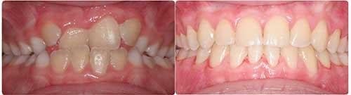 Before and After Orthodontic Treatment Wilsonville Orthodontics in Wilsonville, OR