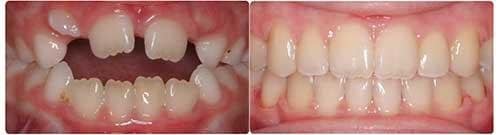 Before and After Orthodontic Treatment Wilsonville Orthodontics in Wilsonville, OR