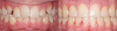 Before and After Orthodontic Treatment Wilsonville Orthodontics in Wilsonville, OR