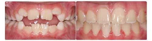 Before and After Orthodontic Treatment Wilsonville Orthodontics in Wilsonville, OR