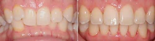 Before and After Orthodontic Treatment Wilsonville Orthodontics in Wilsonville, OR