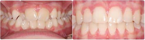 Before and After Orthodontic Treatment Wilsonville Orthodontics in Wilsonville, OR