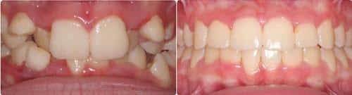 Before and After Orthodontic Treatment Wilsonville Orthodontics in Wilsonville, OR