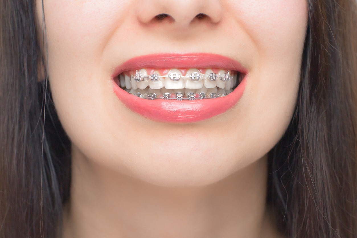 Braces Wilsonville Orthodontics in Wilsonville, OR
