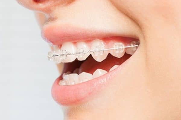 Ceramic Braces Wilsonville Orthodontics in Wilsonville, OR